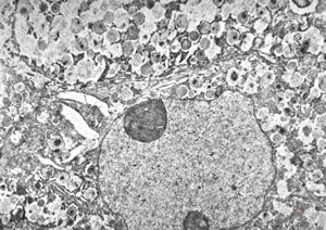M,39y. | lymph node - metastasis of adenocarcinoma M,39y. | lymph node - metastasis of adenocarcinoma